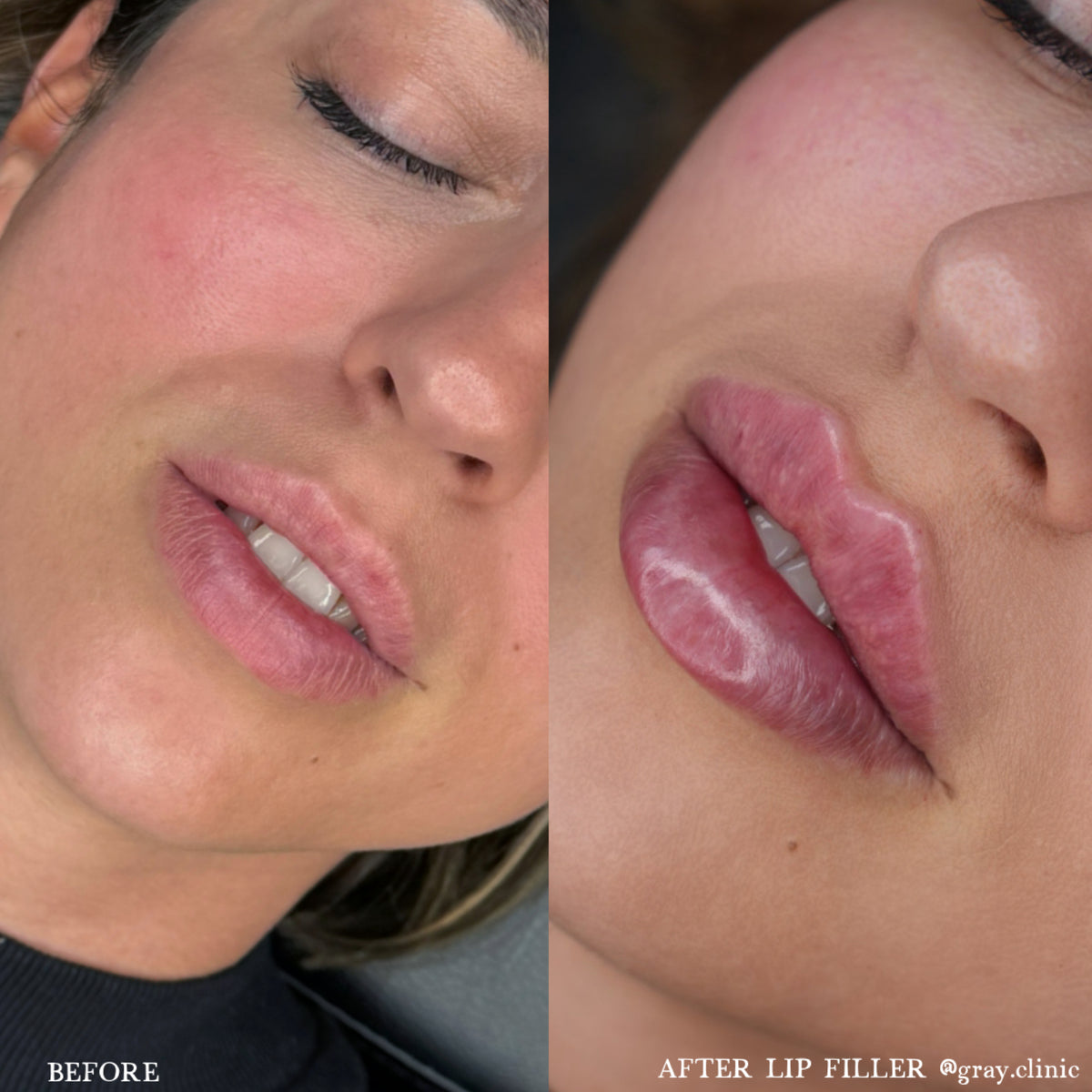 Före och efter läppfiller med Russian Lips-tekniken, GRAY Clinic
