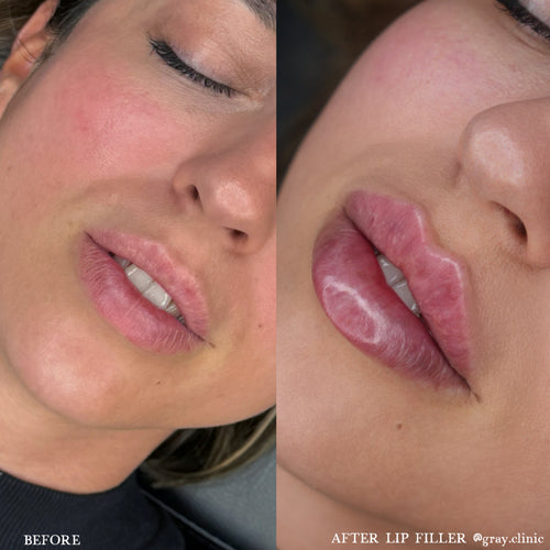 Före och efter läppfiller med Russian Lips-tekniken, GRAY Clinic